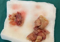 Tricuspid Valve Vegetative Endocarditis