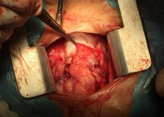 huge anterior mediastinal mass and compression effect on RV 1