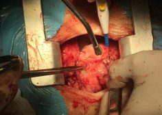 huge anterior mediastinal mass and compression effect on RV 2