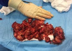 huge anterior mediastinal mass and compression effect on RV 3