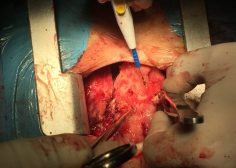 huge anterior mediastinal mass and compression effect on RV 4
