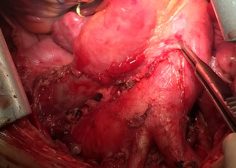 huge anterior mediastinal mass and compression effect on RV 5