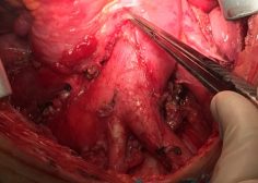 huge anterior mediastinal mass and compression effect on RV 6