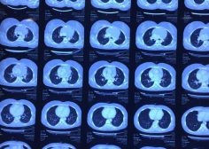 huge anterior mediastinal mass and compression effect on RV 7
