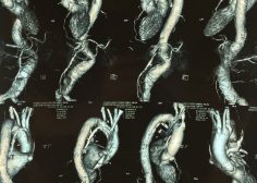 thoracoabdominal aneurysm and mesenteric ischemia 1