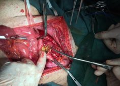 thoracoabdominal aneurysm and mesenteric ischemia 10