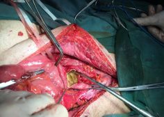 thoracoabdominal aneurysm and mesenteric ischemia 11