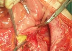 thoracoabdominal aneurysm and mesenteric ischemia 12