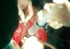 thoracoabdominal aneurysm and mesenteric ischemia 13