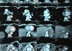 thoracoabdominal aneurysm and mesenteric ischemia 3