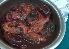 thoracoabdominal aneurysm and mesenteric ischemia 4