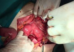 thoracoabdominal aneurysm and mesenteric ischemia 5