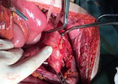thoracoabdominal aneurysm and mesenteric ischemia 6