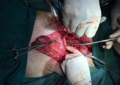 thoracoabdominal aneurysm and mesenteric ischemia 7