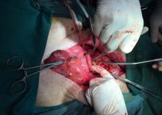 thoracoabdominal aneurysm and mesenteric ischemia 8