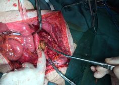 thoracoabdominal aneurysm and mesenteric ischemia 9