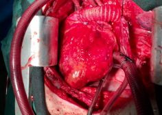 tumoral encasement of LT pulmonary artery 1