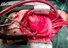tumoral encasement of LT pulmonary artery 2
