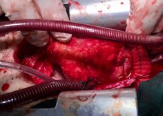 tumoral encasement of LT pulmonary artery 3