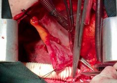 tumoral encasement of LT pulmonary artery 4