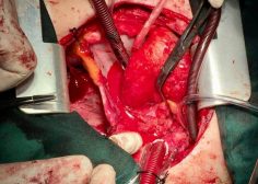 tumoral encasement of LT pulmonary artery 5