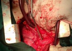 tumoral encasement of LT pulmonary artery 6