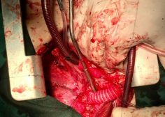 tumoral encasement of LT pulmonary artery 7