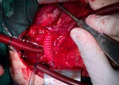 tumoral encasement of LT pulmonary artery 8