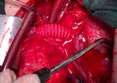 tumoral encasement of LT pulmonary artery 9