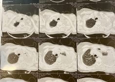 left pulmonary malignancy and occlusion effect on LPA 1