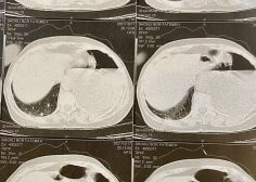 left pulmonary malignancy and occlusion effect on LPA 2