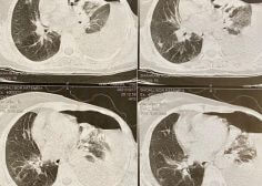 left pulmonary malignancy and occlusion effect on LPA 3