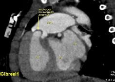valvular pulmonary atresia 1