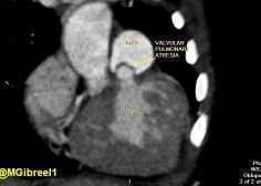valvular pulmonary atresia 2