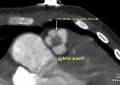 valvular pulmonary atresia 3