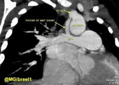 valvular pulmonary atresia 4