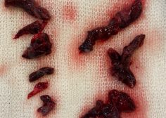 pulmonary embolectomy with Zeraatian single incision technique