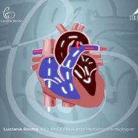PCA, Persistência do Canal Arterial – Persistent Ductus Arteriosus