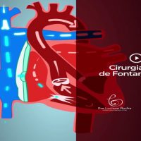 Cirurgia de Fontan