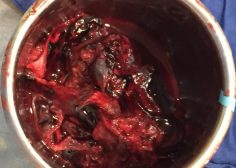 mediastinal fistula
