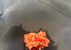 tricuspid valve bacterial endocarditis