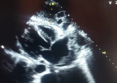 post operative constrictive pericarditis1