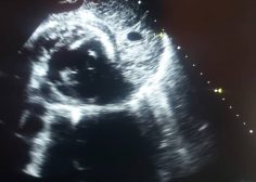 post operative constrictive pericarditis2