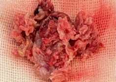 mass excision and autologous tissue reconstruction of RA