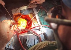 Aortic root abcess and fistula from ascending aorta to RA1