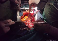 Aortic root abcess and fistula from ascending aorta to RA2