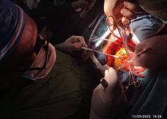 Aortic root abcess and fistula from ascending aorta to RA3