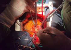 Aortic root abcess and fistula from ascending aorta to RA4