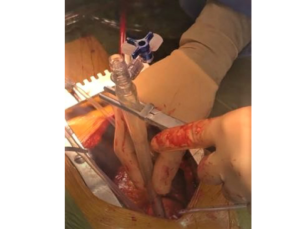 Canulacion-aortica-arreglada