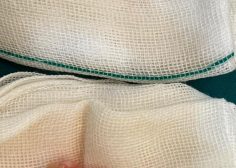 Complete SVC occlusion with SVC syndrome